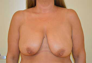 Breast Lift