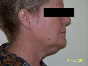 Facelift & Neck Lift