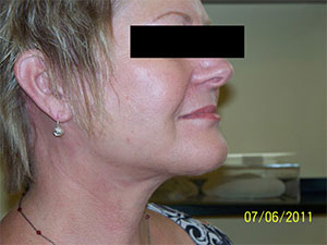 Facelift & Neck Lift