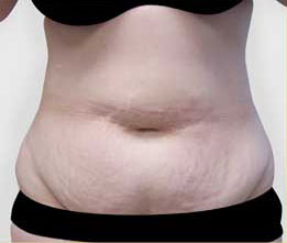 Tummy Tuck