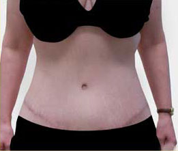 Tummy Tuck