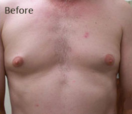 Male Breast Reduction Before & After