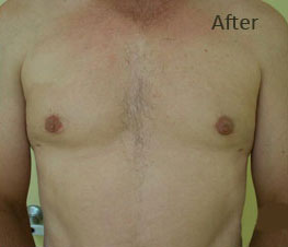 Male Breast Reduction Before & After