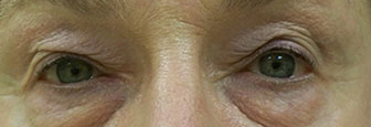 Eyelid Lift