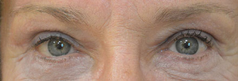 Eyelid Lift